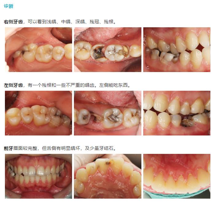 经典案例|龋齿、残根、怕看牙?一位牙病患者的华丽转身